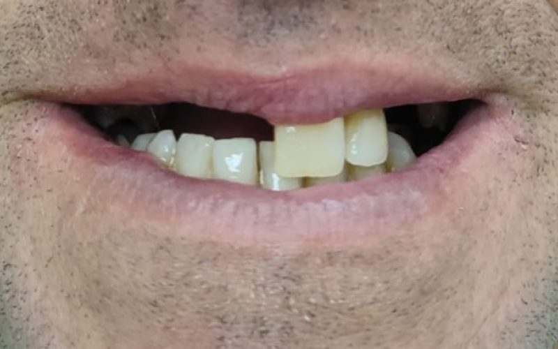 Antes sonrisa