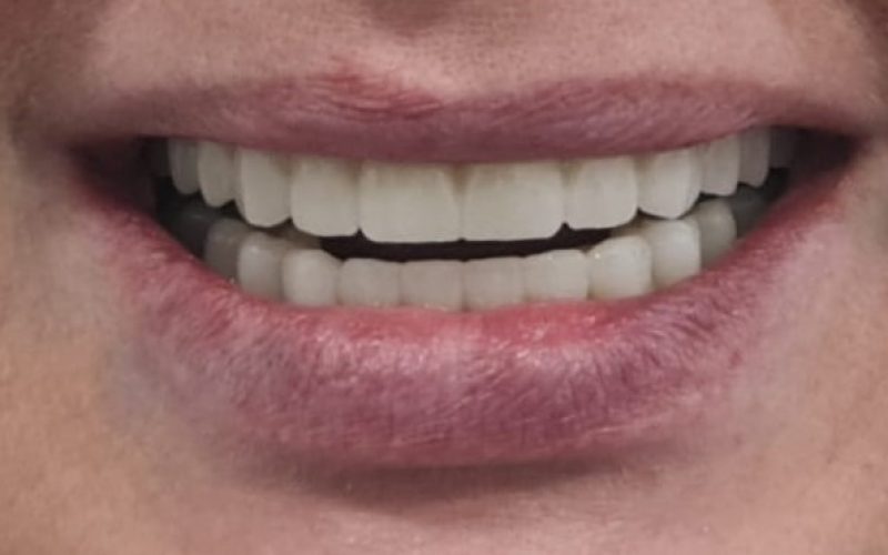 DESPUÉS SONRISA