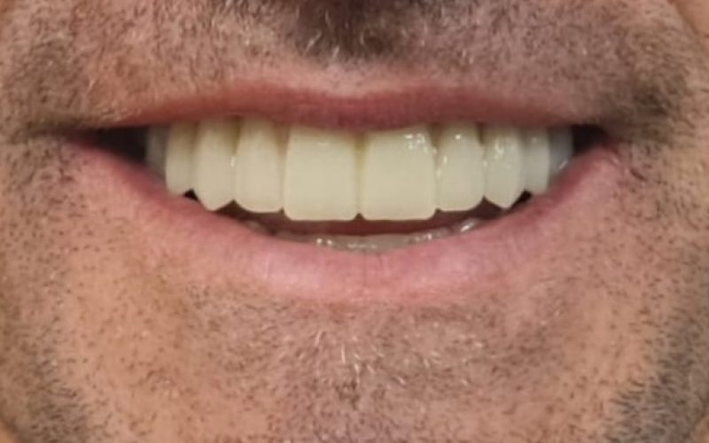 después sonrisa