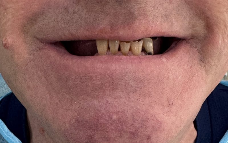 sonrisa antes