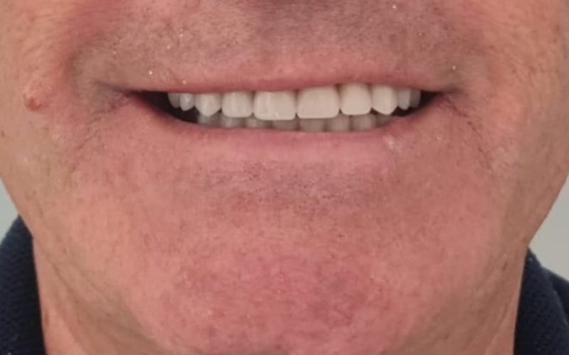 sonrisa después